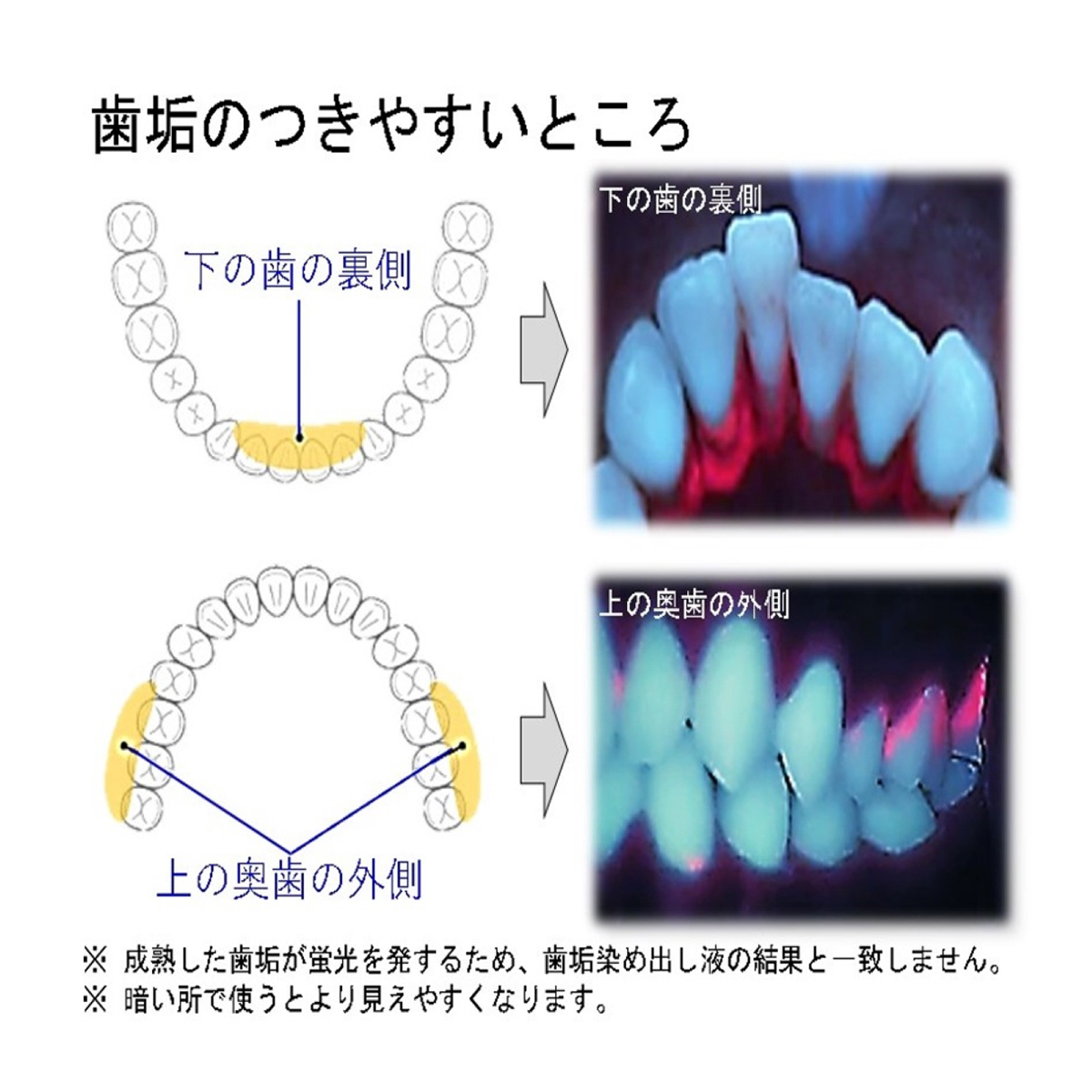 デンタルライト