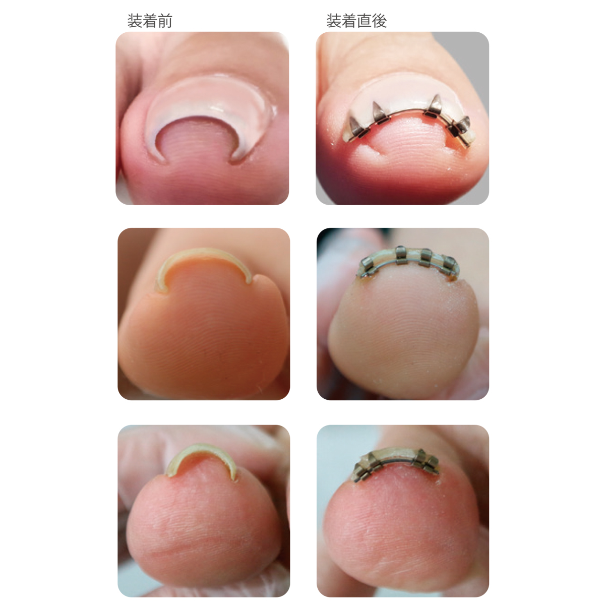 まきづめリフト